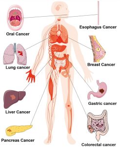 Types of cancers